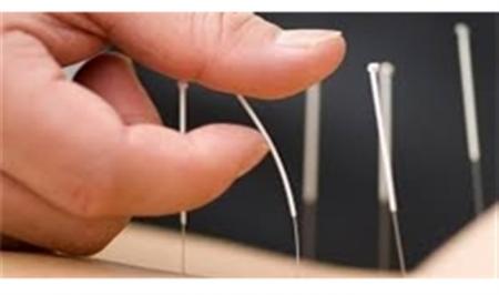 بیماری‌هایی که با طب‌سوزنی درمان می‌شوند