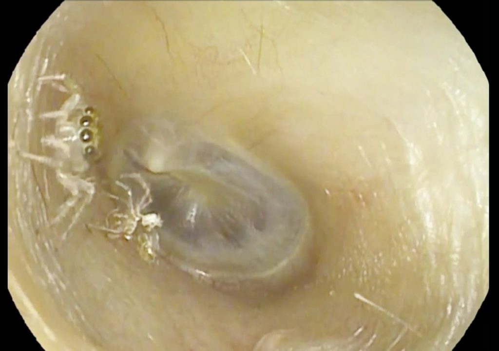 بیرون آوردن عنکبوت از یک گوش زن ۶۴ ساله! + ویدیو