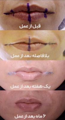 عکس شگفت از جراحی کوچک کردن دهان که به تازگی مد شده+عکس_راسخ