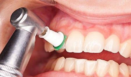 جرم‌گیری مینای دندانتان را تحلیل می‌برد؟_راسخ
