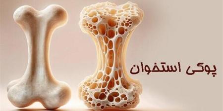 بیماری خاموشی که بی‌صدا استخوان‌ها را می شکند_راسخ